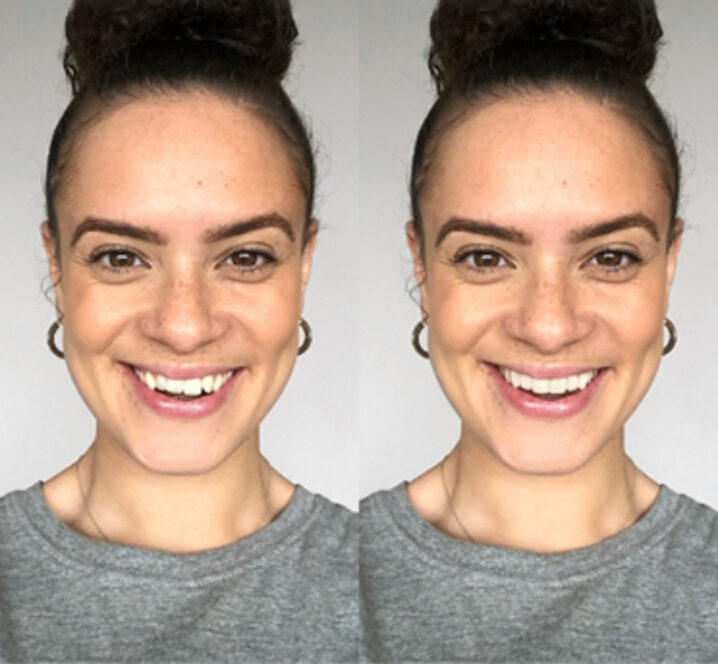 Invisalign - Before and after