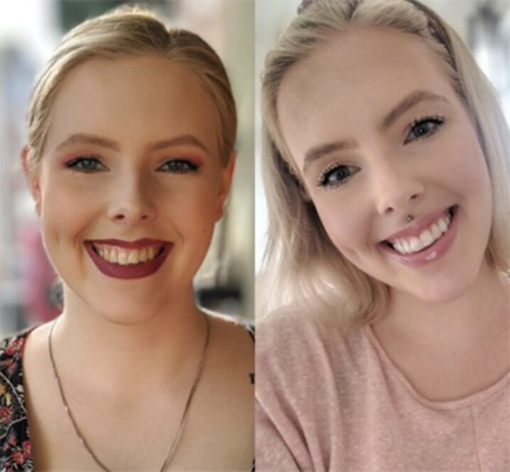Invisalign - Before and after Case