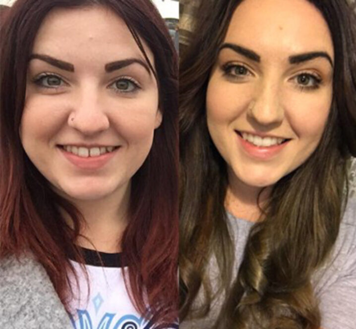 Invisalign Aligners - Before and after