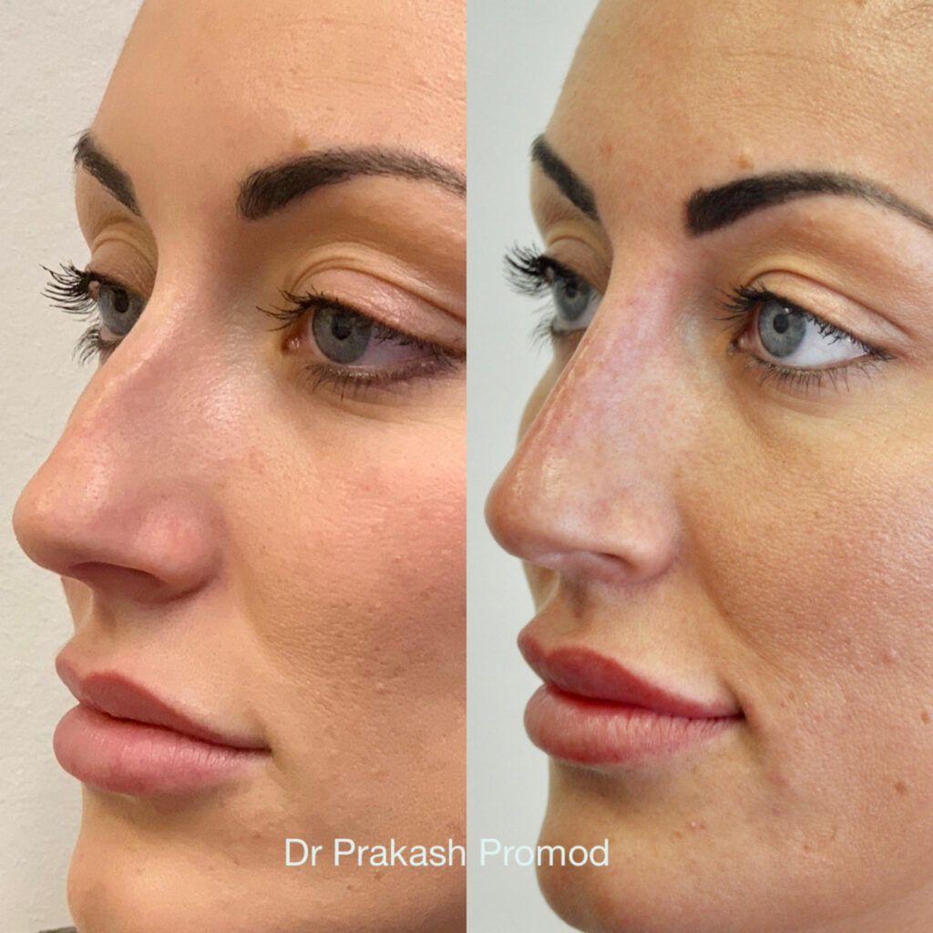 injectable nose job