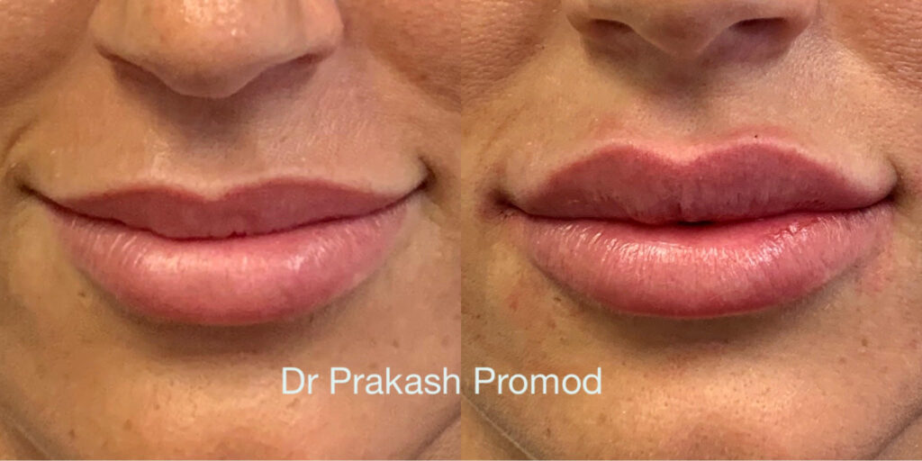 Lip fillers