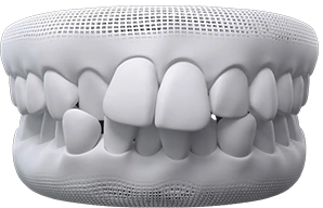 Crowded teeth treatment