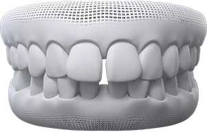 Gapped Teeth treatment