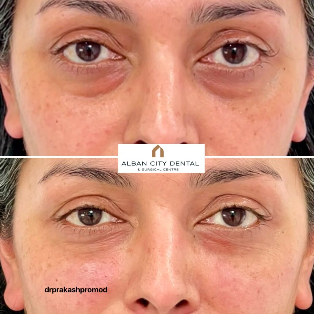 Under eye treatments