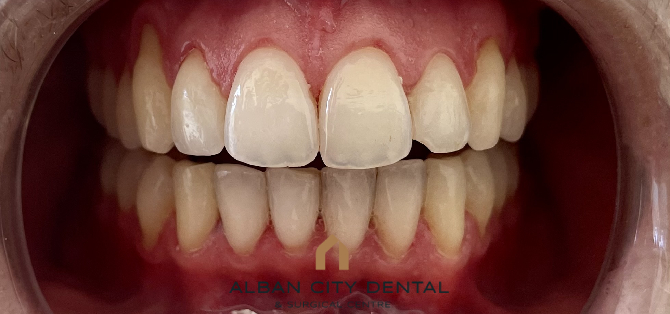 Airflow oral hygiene treatment - after