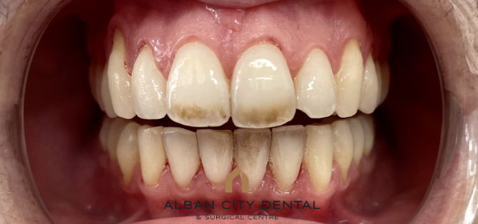 Airflow oral hygiene treatment - before