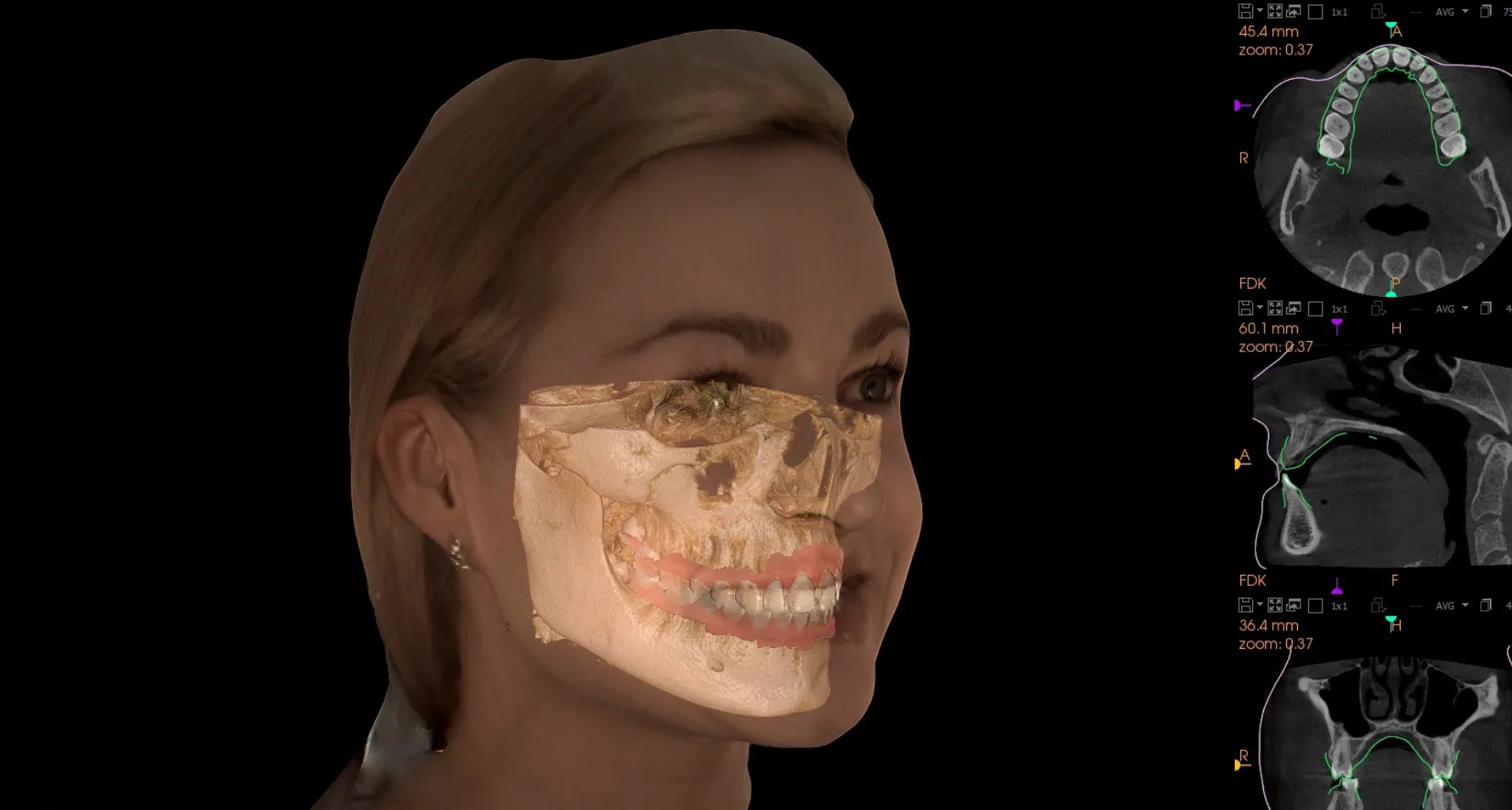 CBCT image CBCT image