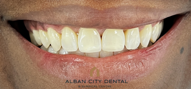 Composite Edge Bonding - After