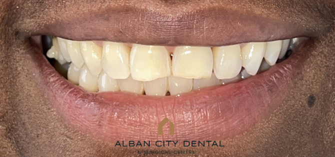 Composite Edge Bonding - Before