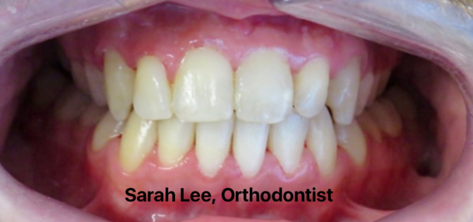 Orthodontics and surgery (complex) - after