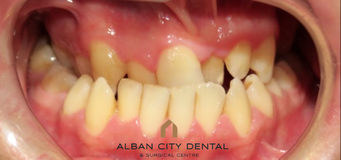 Orthodontics and surgery (complex) - before
