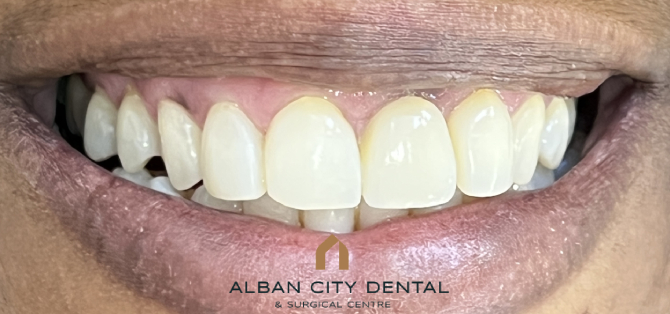 Single-Tooth Dental Implant - After