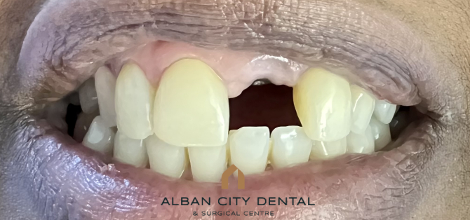 Single-Tooth Dental Implant - Before