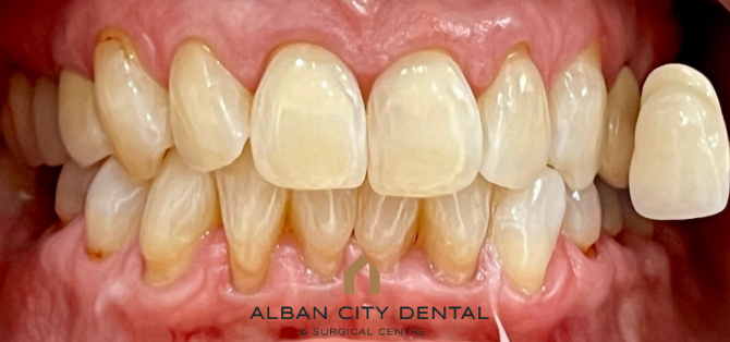 Teeth Whitening - After