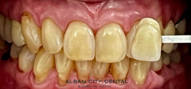Teeth Whitening - Before