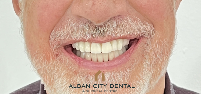 Teeth in a Day - Ater