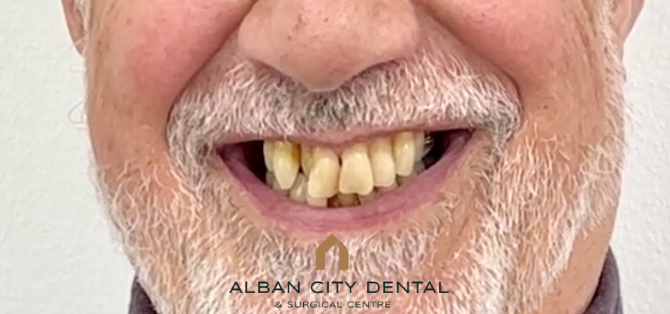 Teeth in a Day - Before