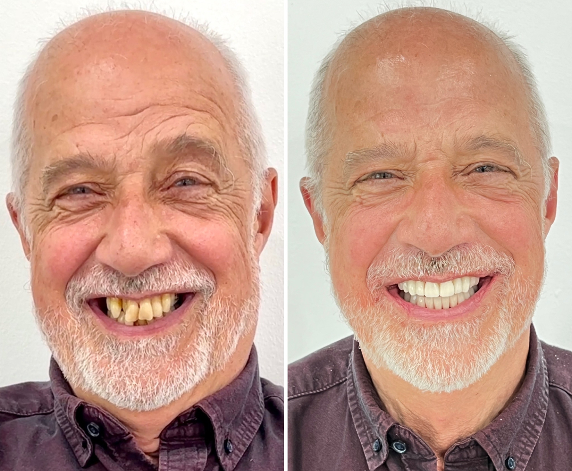 Teeth in a day Before and after photos of teeth in a day