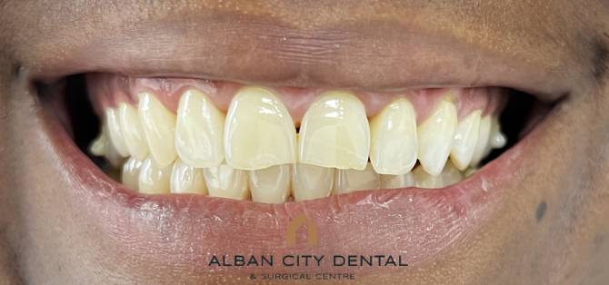 Teeth Whitening - After