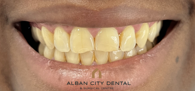 Teeth Whitening - Before