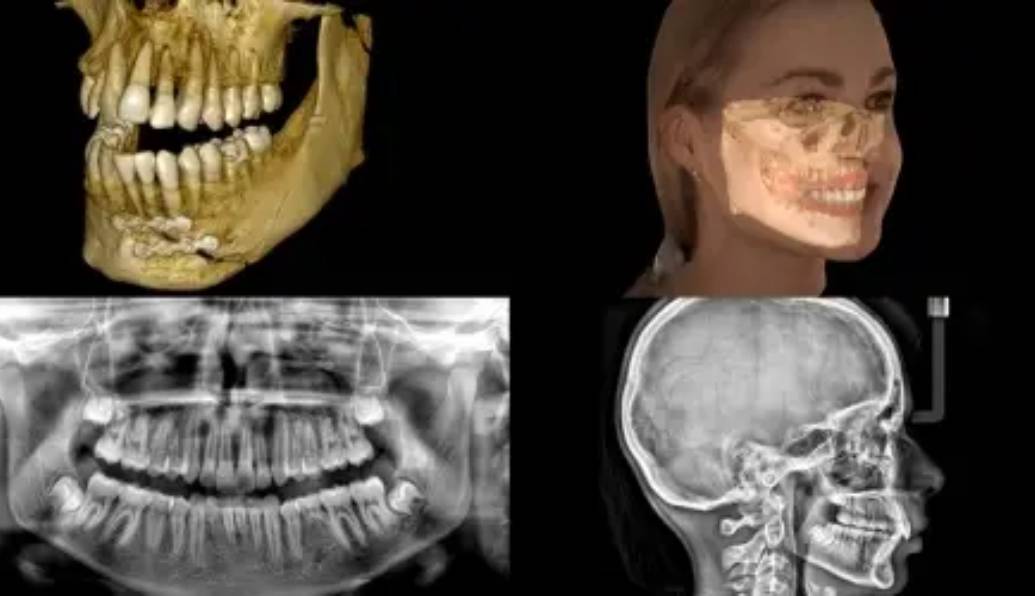 3D facial scanning with the Carestream 9600 Cone Beam Computed Tomography (CBCT) scanner