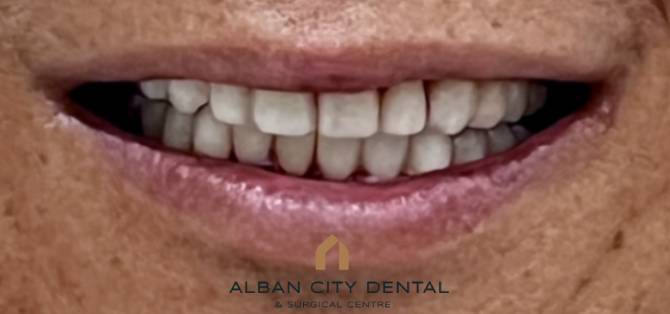 Teeth in a day Case 2 - After