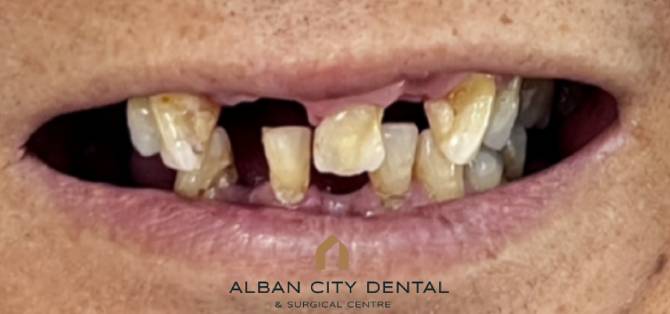 Teeth in a day Case 2 - Before