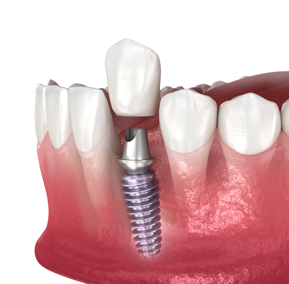 Dental crown and implant