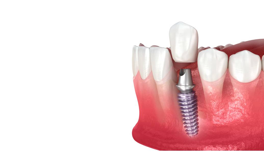 Dental Implant