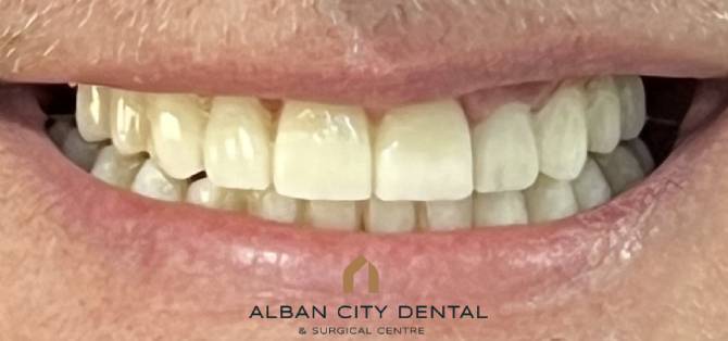 All On Six Dental Implants - After