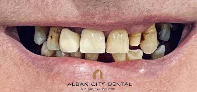 All On Six Dental Implants - Before