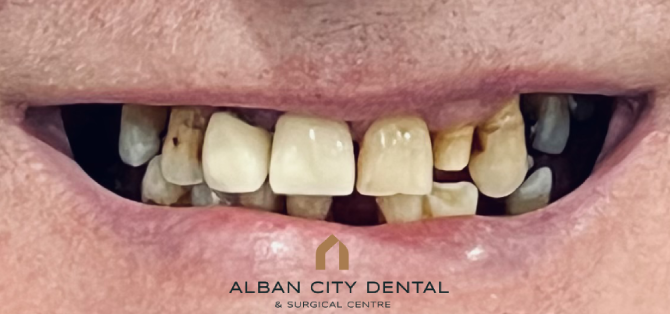 Teeth in a day with guided implants - Before