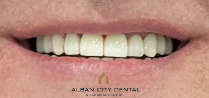 Teeth in a day with guided implants - After