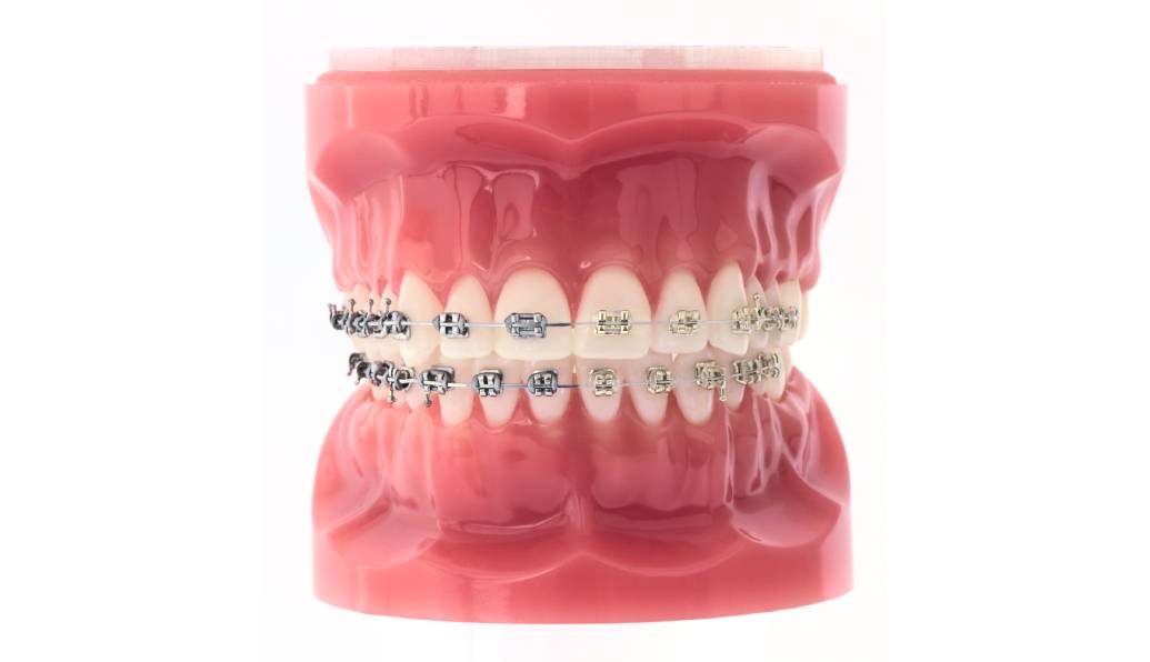 Iconix bracket comparison