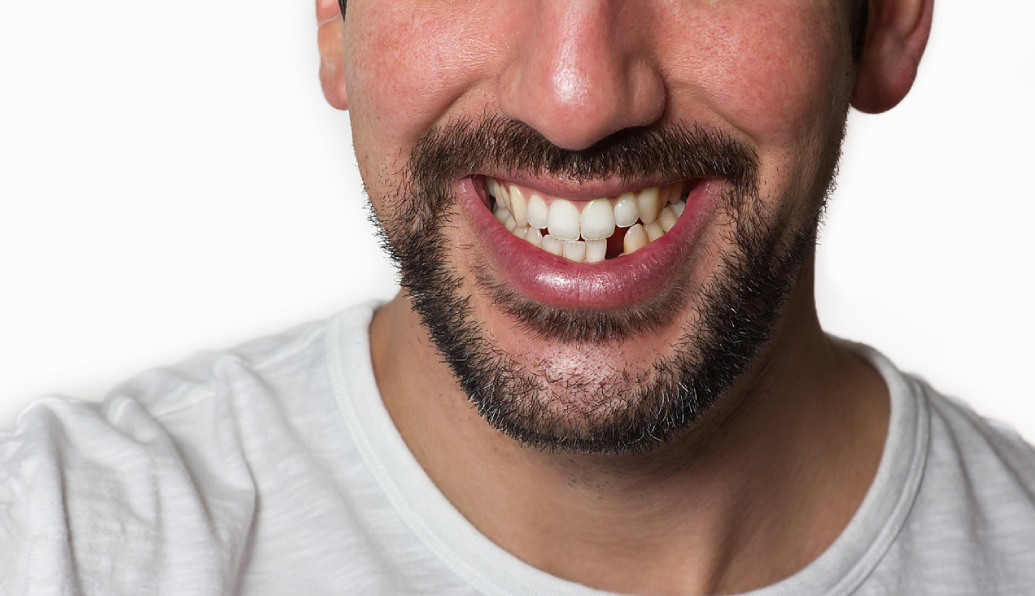 man missing a tooth