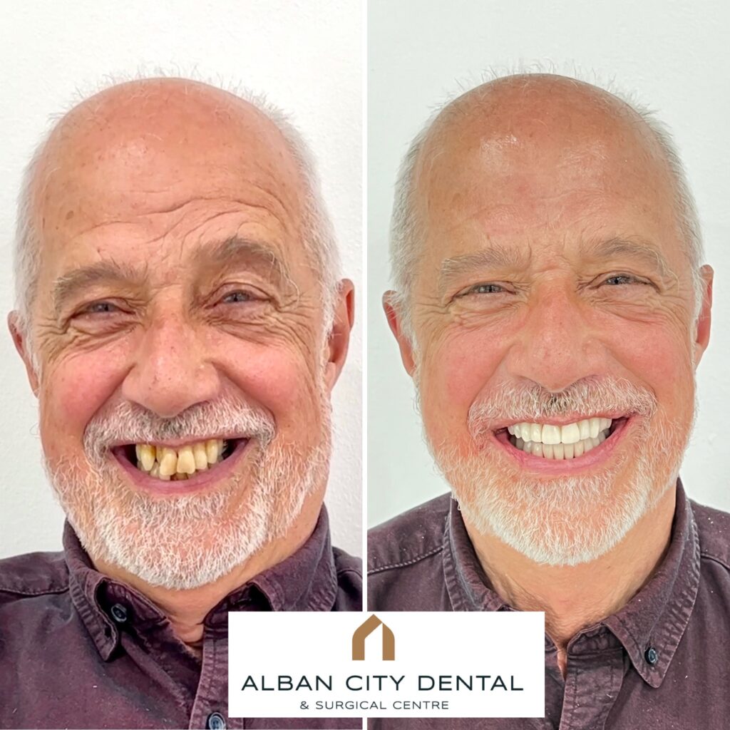 Teeth in a Day smile transformation