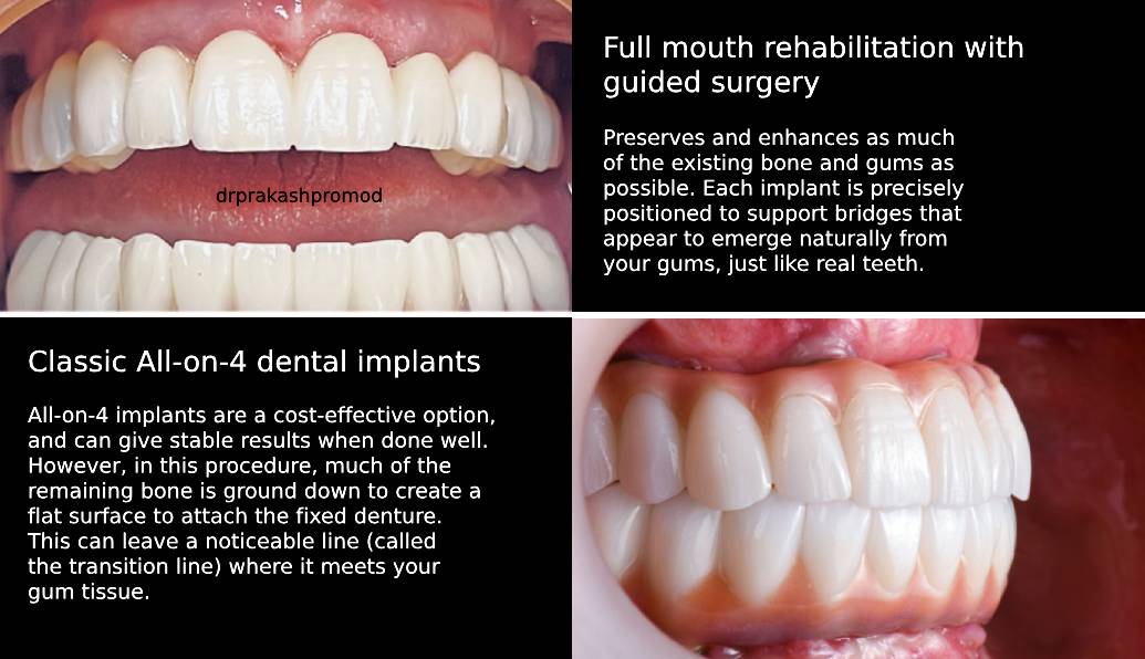 All-on-4 implants vs full mouth rehab with guided surgery
