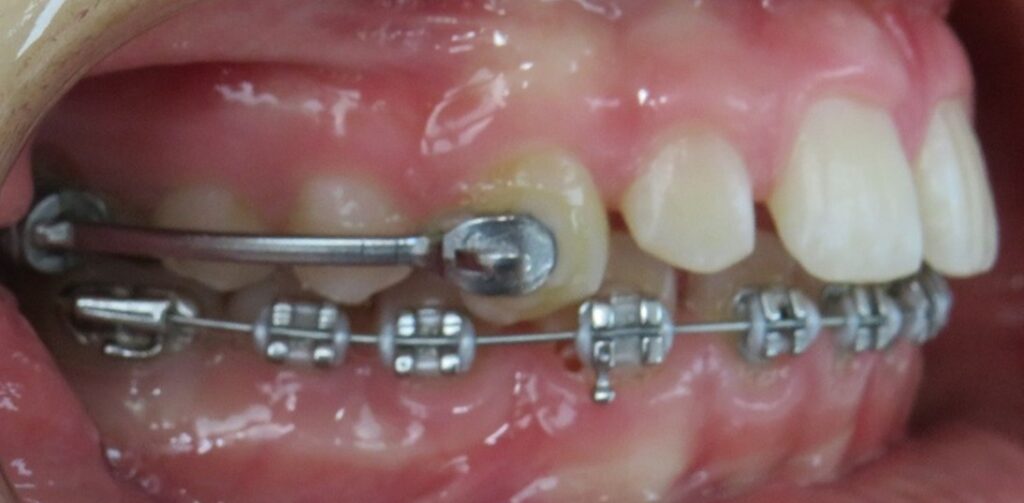 Patient receiving orthodontic treatment with the PowerBar Class II Corrector