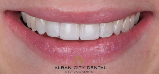 composite bonding - after