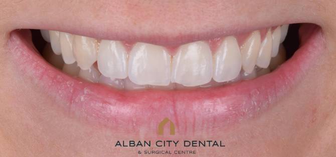 composite bonding - before