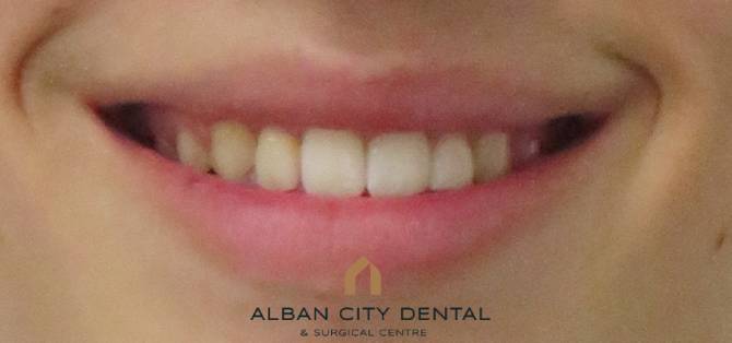 Invisalign Teen - after