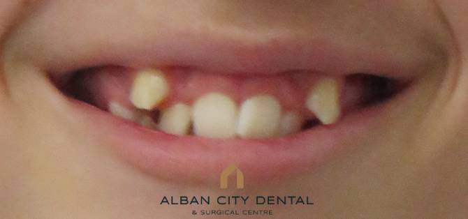 Invisalign Teen - before