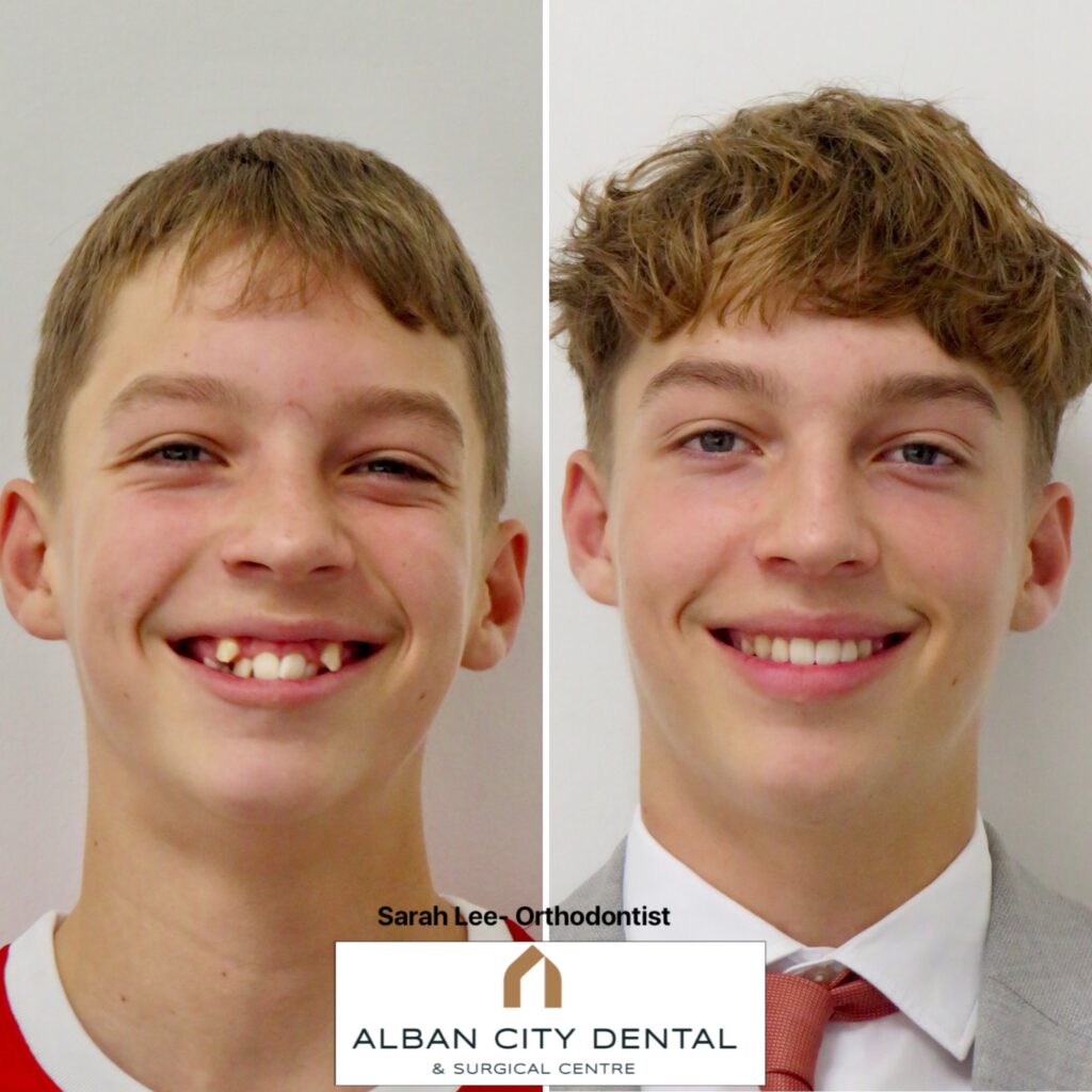 Invisalign Teen before and after