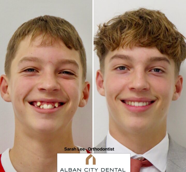 Invisalign Teen before and after