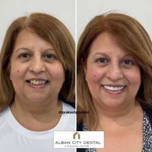 Before and after dental implants