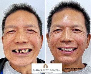 Before and after teeth in a day