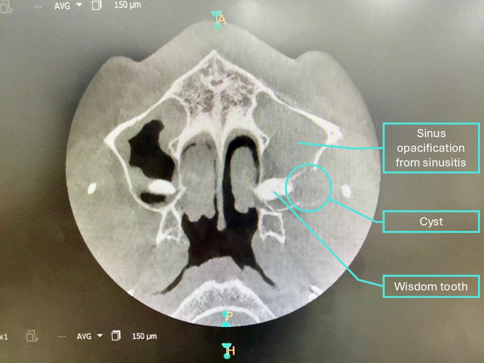 scan of a wisdom tooth with cyst