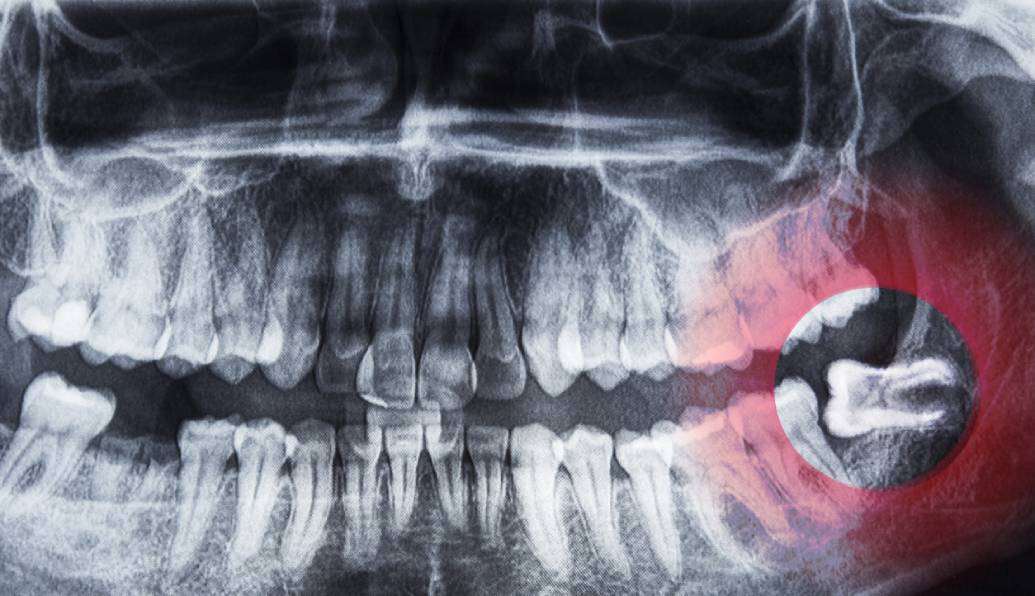 wisdom tooth extraction wisdom tooth extraction